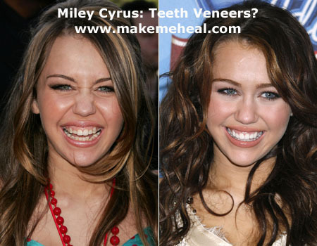 miley-cyrus-teeth-veneers - Miley Cyrus