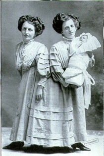 siamezele Josefa & Rosa Blazeh  1910; Josefa &amp; Rosa Blazeh cu fiul Rosei.Ele au trait intre 1878-1922.sint singurele siameze acre au dat nastere unui copil

