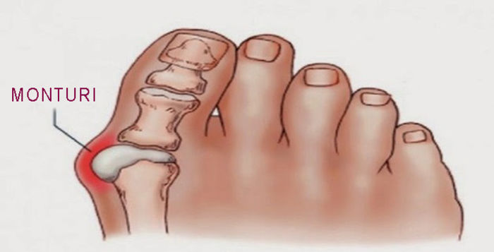 Leac pentru monturi; vezi comentariul :Leac pentru monturi - Hallux Valgus
