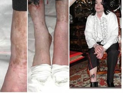 michael-jackson-legs-vitiligo-wound - poze mj