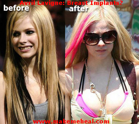 avril-lavigne-breast-implants - Avril lavinge