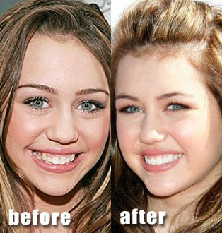 miley-cyrus-teeth - hannah montana