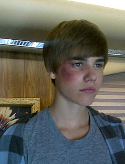 thumb_size1 - Justin Bieber cu ochiul invinetit