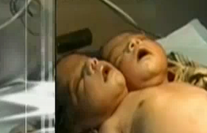 tulburator-bebelusul-care-s-a-nascut-cu-doua-capete-video_size6 - bebelus cu 2 capepte