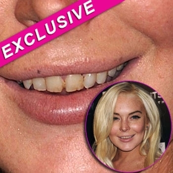 Lindsay-Lohan-teeth-dentist-INF_0 - mi-a luat 10 minute