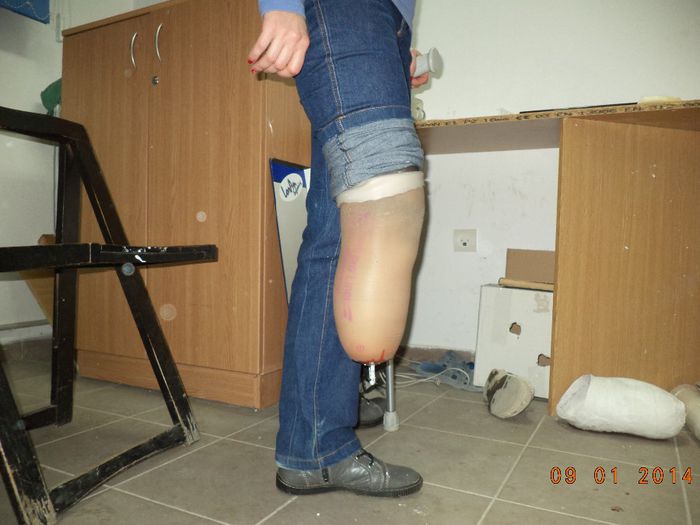 2014-01-09 13.04.49 - proteze amputatii