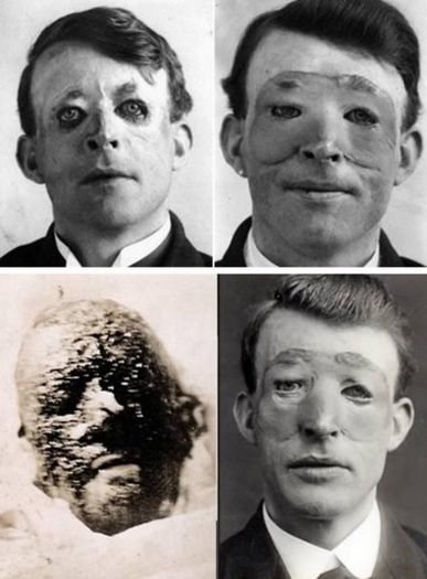 primul transplant de piele-1917 - fotografii inedite din istorie