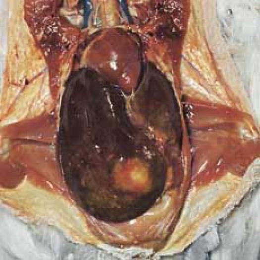 trichomonoza-disectie galben in ficat - Simptome boli NET