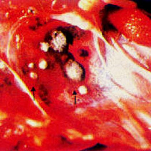 aspergilloza-disectie la plamani, ciuperca de aspergiloza
