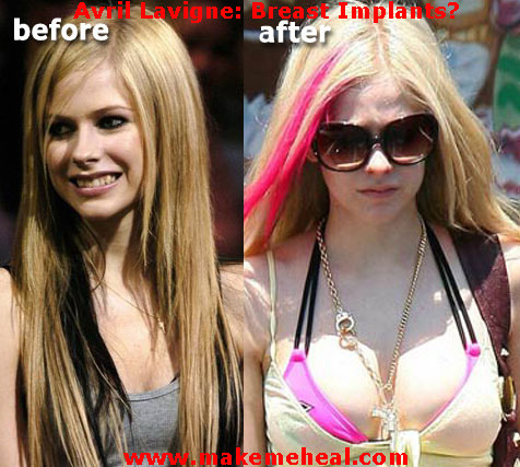 avril-lavigne-breast-implants - AVril Lavigne