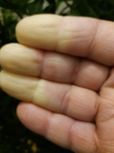 IMG-20181220-WA0001; Asa sunt degetele in  sindromul Raynaut .In prezenta frigului se albesc dupa care la caldura se invinetesc  si apoi sa inrosesc foarte tare .
