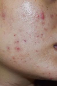 de la operatie incoace ma confrunt cu o acnee de toata frumusetea, desi nu mai am probleme; de la 16 ani dupa 15 mii de tratamente - am mers iar la dermatolog si am inteles ca e normal??? and medical explanation blah blah lss; e urata si pare ft dry desi ma super hidratez zilnic.
