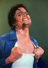 vitiligo1