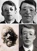 primul transplant de piele-1917